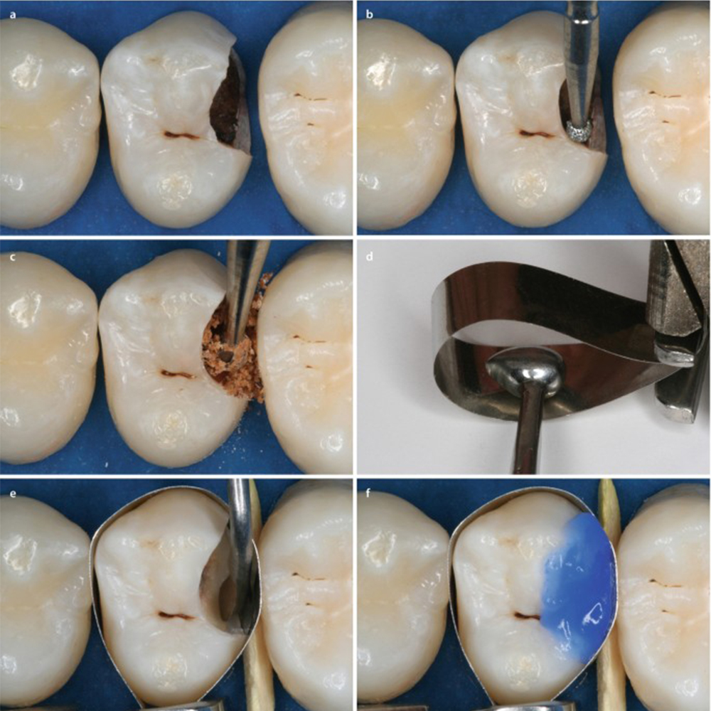 GDC Egg Burnisher - 1 (Bb27/29)