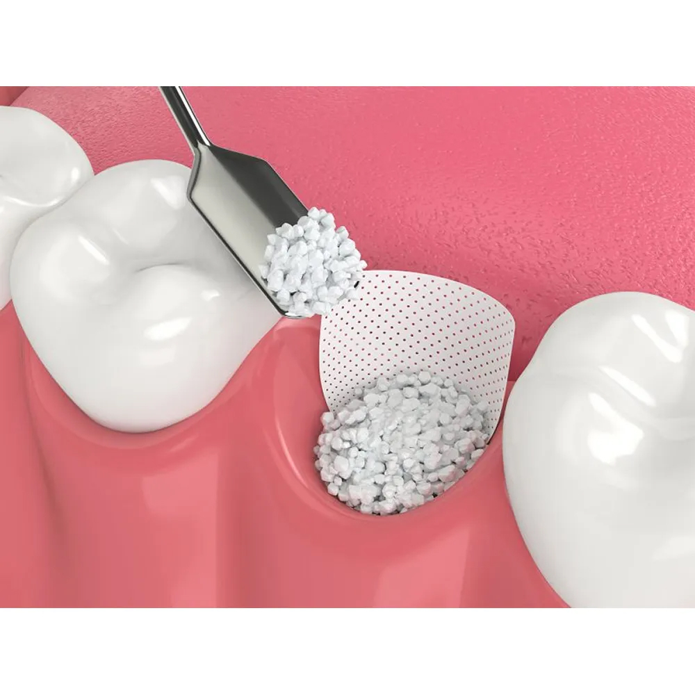 GDC Bone Grafting Instruments - Carrier (BC14615)