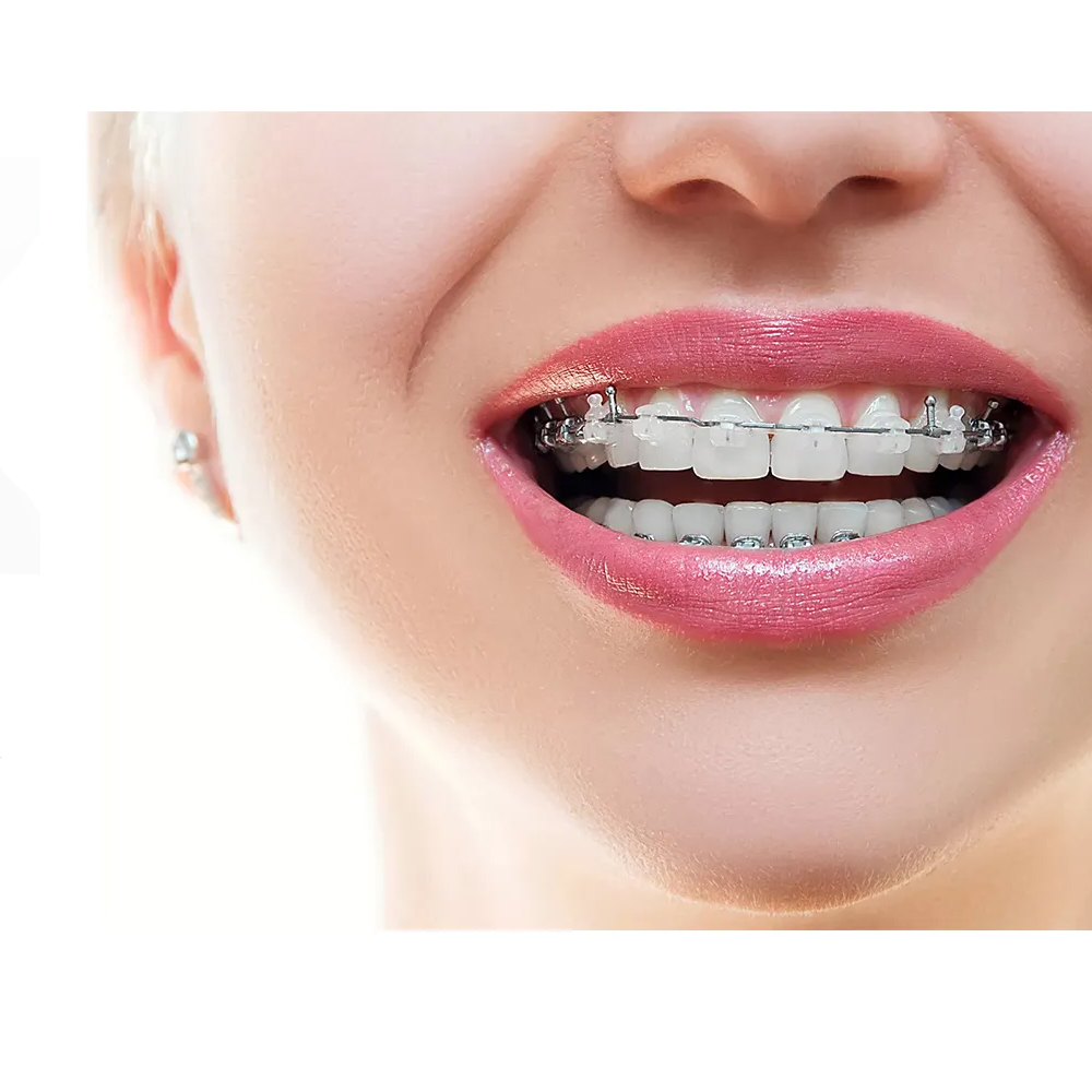 Koden Heat Activated NiTi Archwires - Round (Pack of 5)