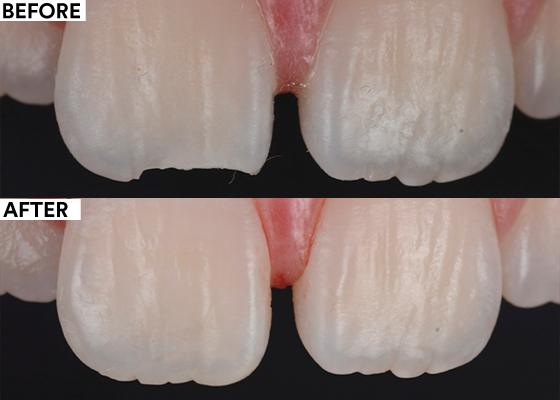 Waldent Alchem NanoFlow Zirconium Flowable Composite Kit (Pack of 4)