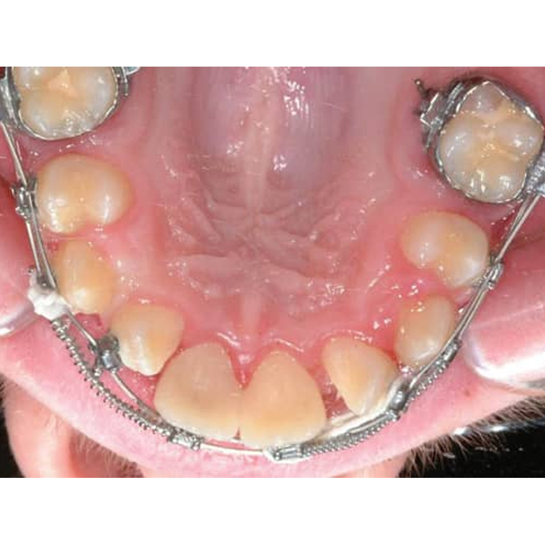 OSL Beta 3 Titanium CNA Intrusion Extrusion Archwires Long (Pack Of 5)