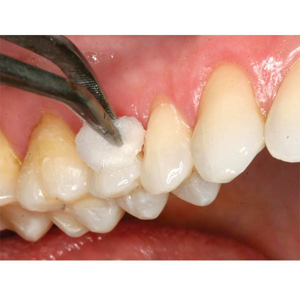 GC Fuji Varnish (5gm)