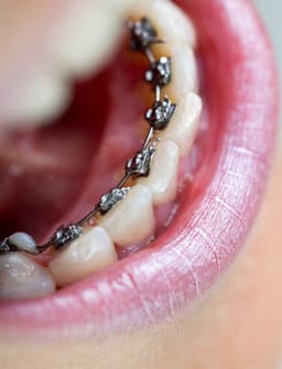U Ortho Lingual Brackets 018 - 13