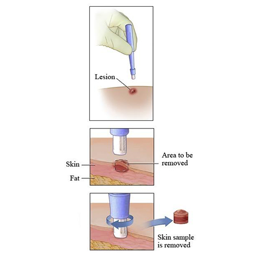 Disposable Biopsy Punch Standard