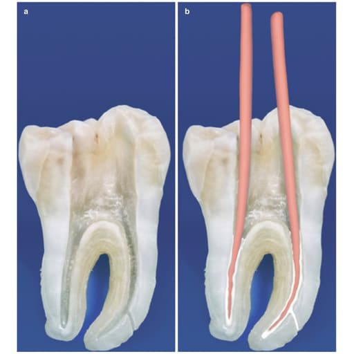 Prime Dental BioTemp Bioceramic Intra Canal Temporary Filling Material