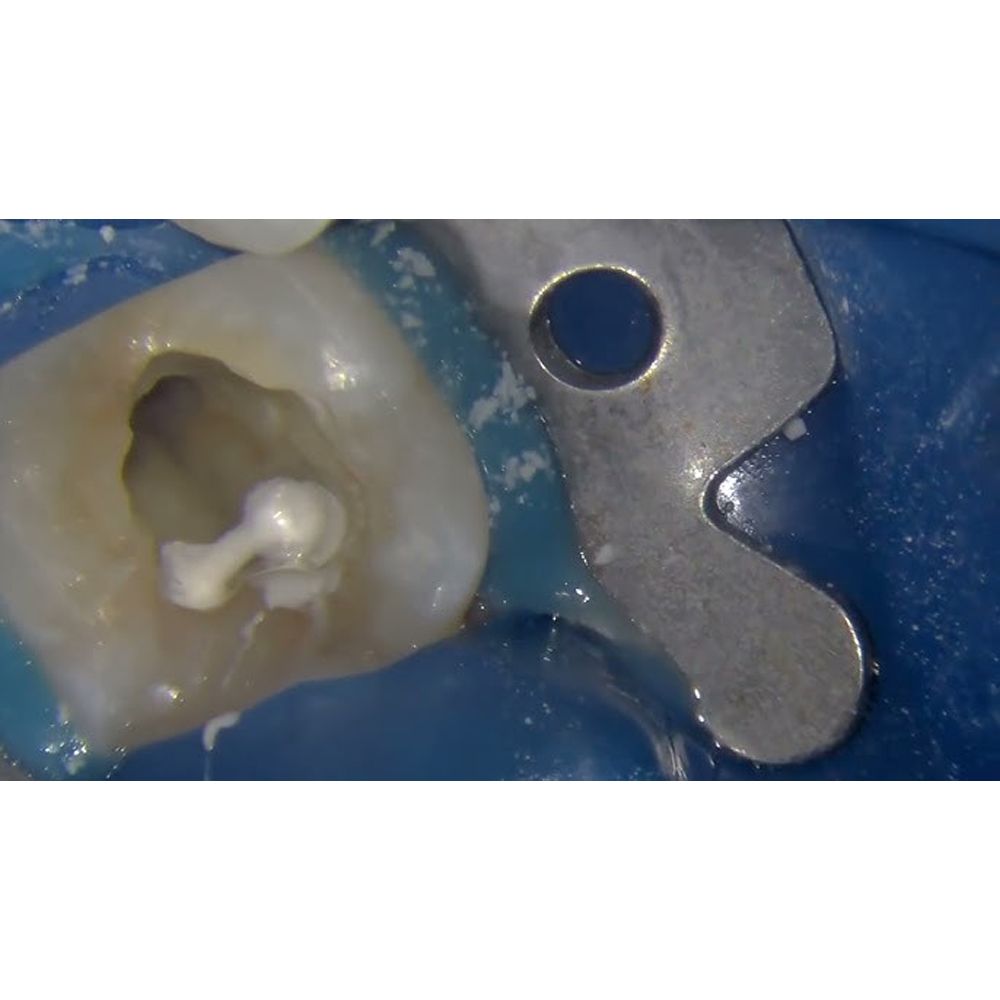 Prime Dental BioTemp Bioceramic Intra Canal Temporary Filling Material