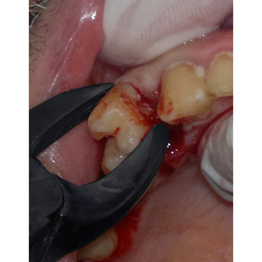 GDC Black Plasma Coated Extraction Forcep Kit