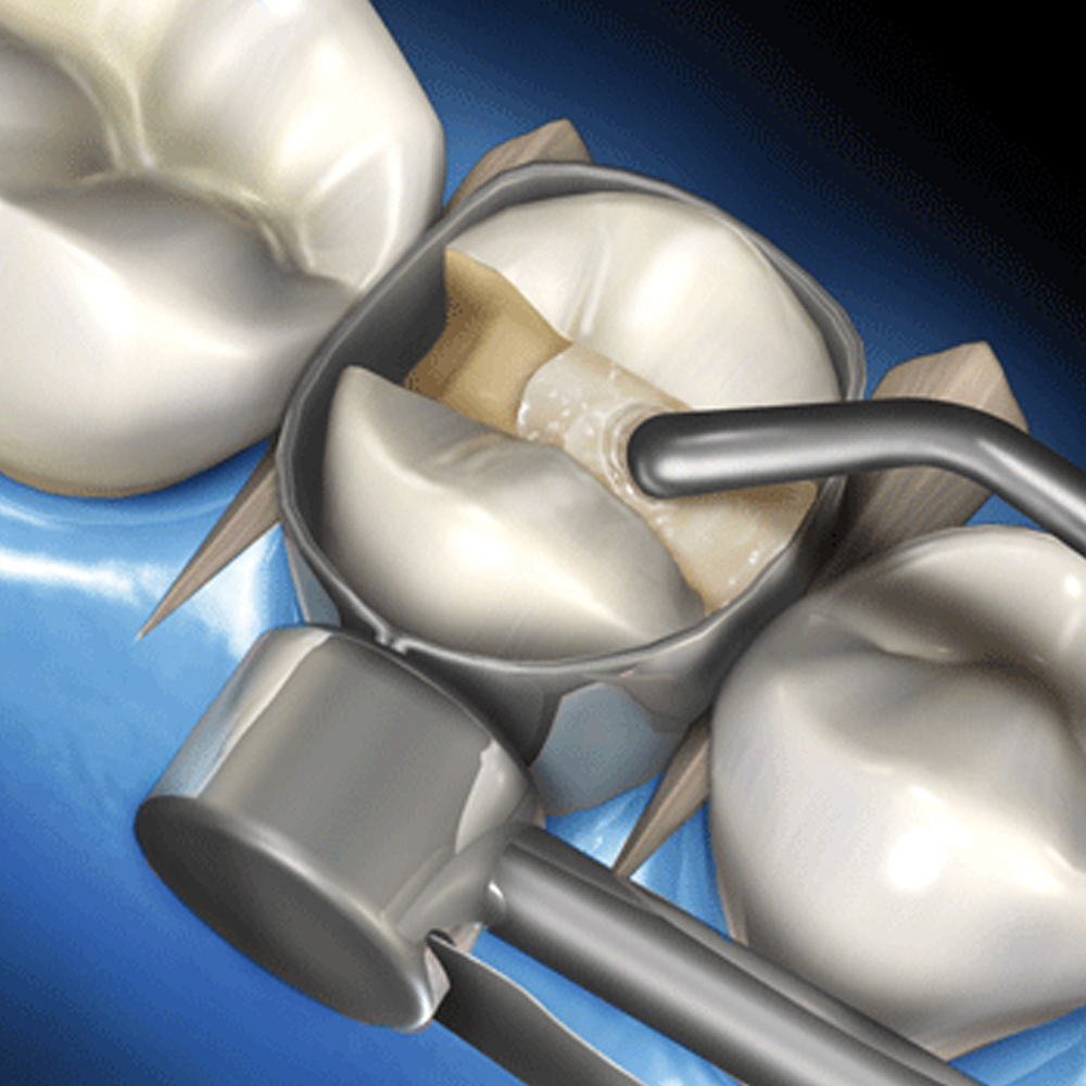 GDC Composite Instrument Plasma Black Silicone Handle Set of 6