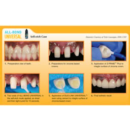 Bisco All Bond Universal LC Adhesive 4ml - 9