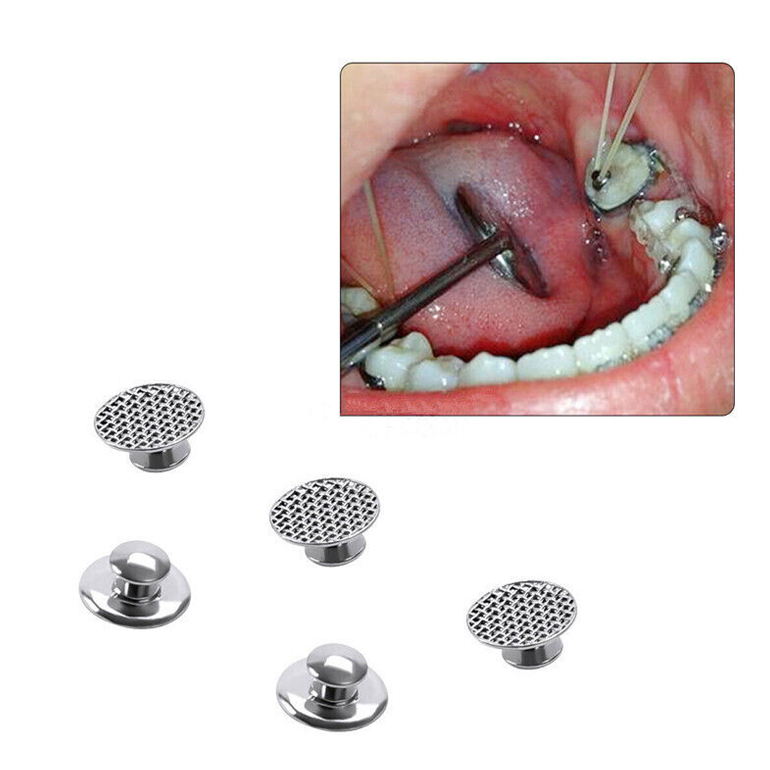 OSL Bondable Lingual Buttons (Pack Of 10)