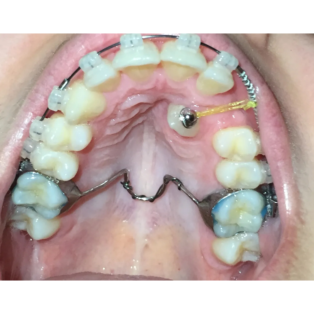 OSL Bondable Lingual Buttons (Pack Of 10)