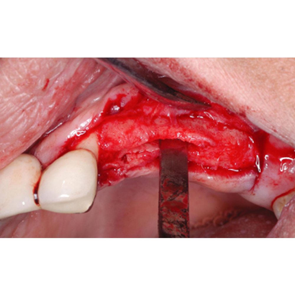 Oracraft Chandler Bone Chisel - 7mm (CC9)