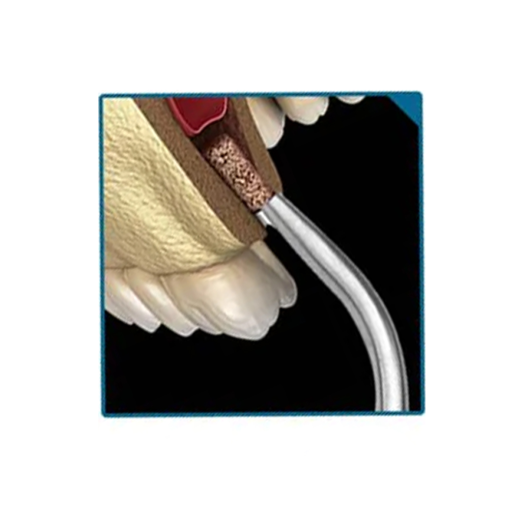 GDC Bone Collector (12mm) (BC1331/2)