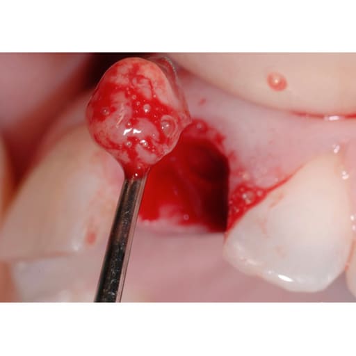 GDC Bone Curette Hemingway #4 (CH879)