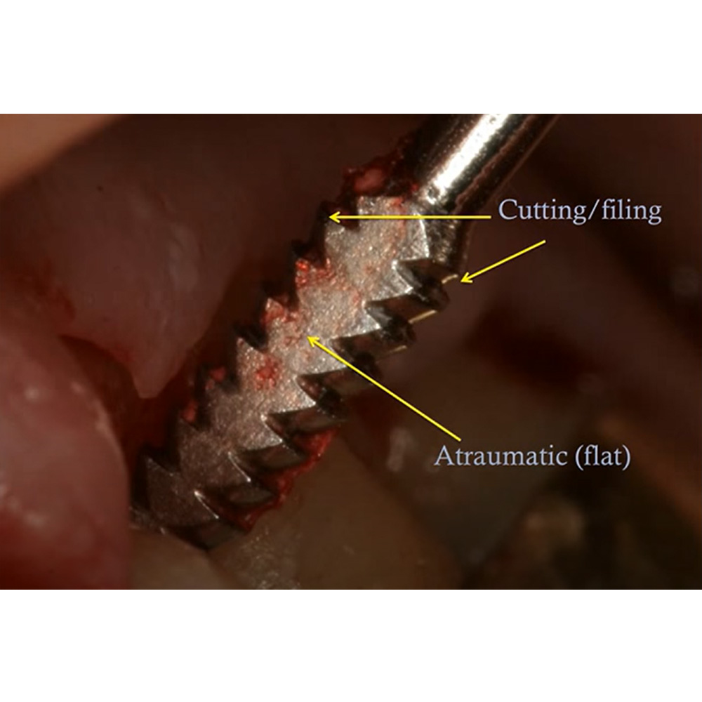 GDC Schluger Bone File #6 (Fs9/10s)