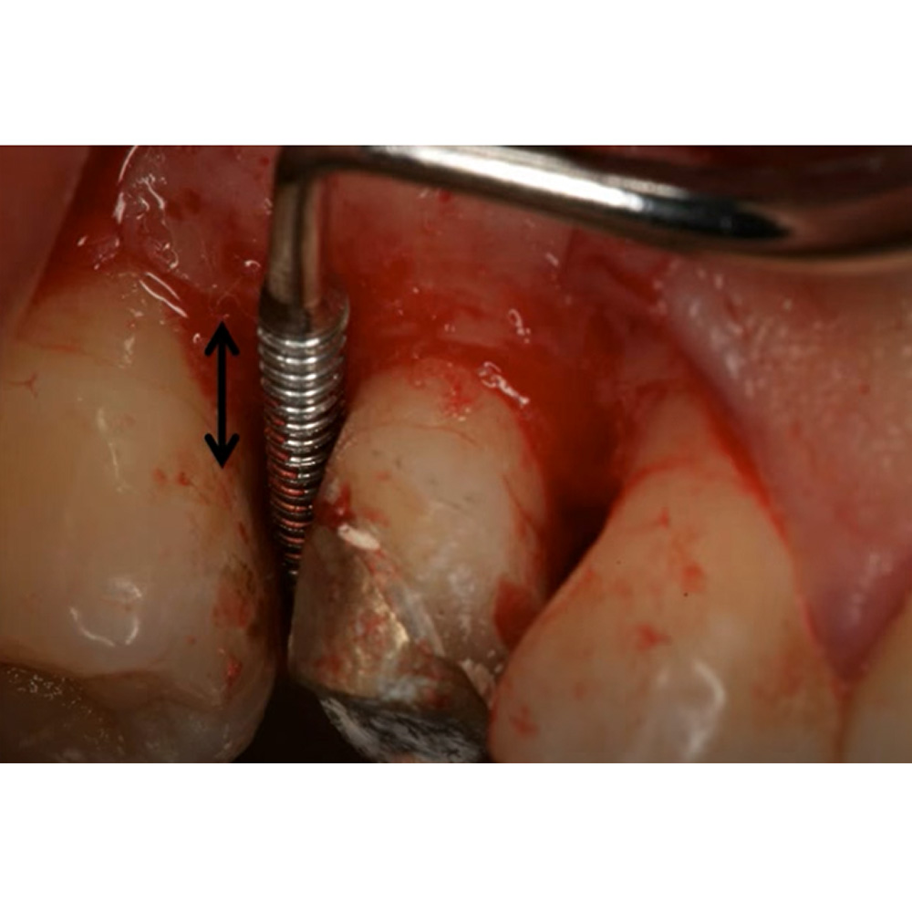 GDC Schluger Bone File #6 (Fs9/10s)