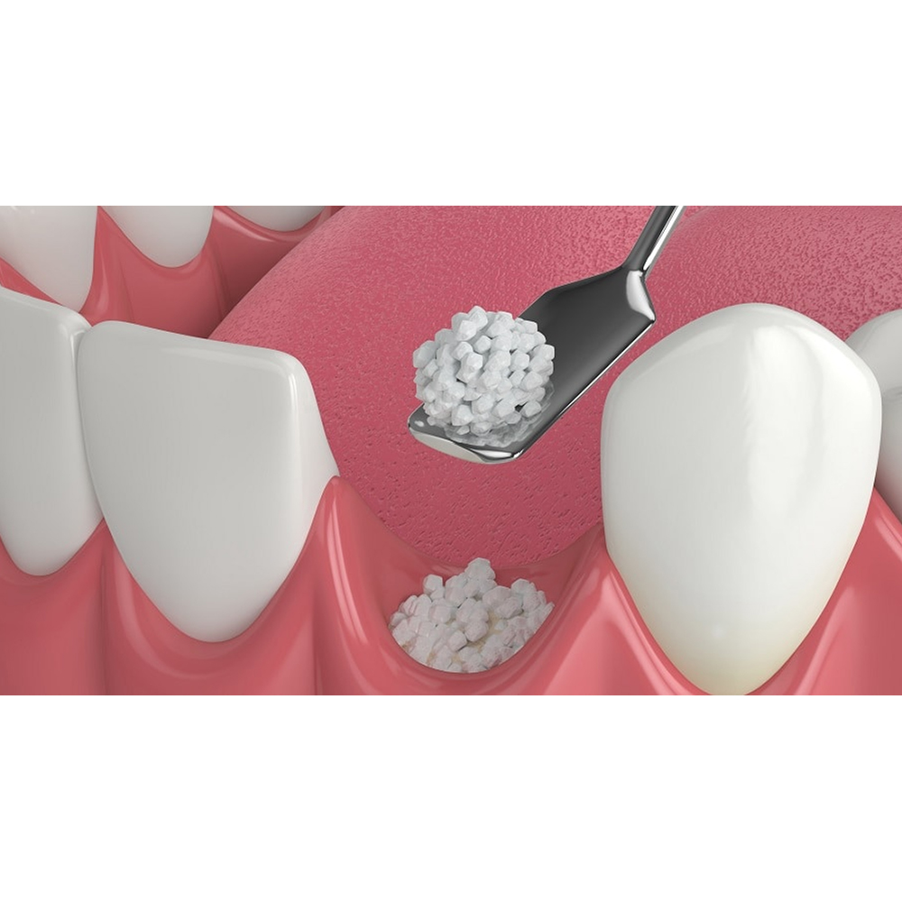 GDC Bone Grafting Instruments