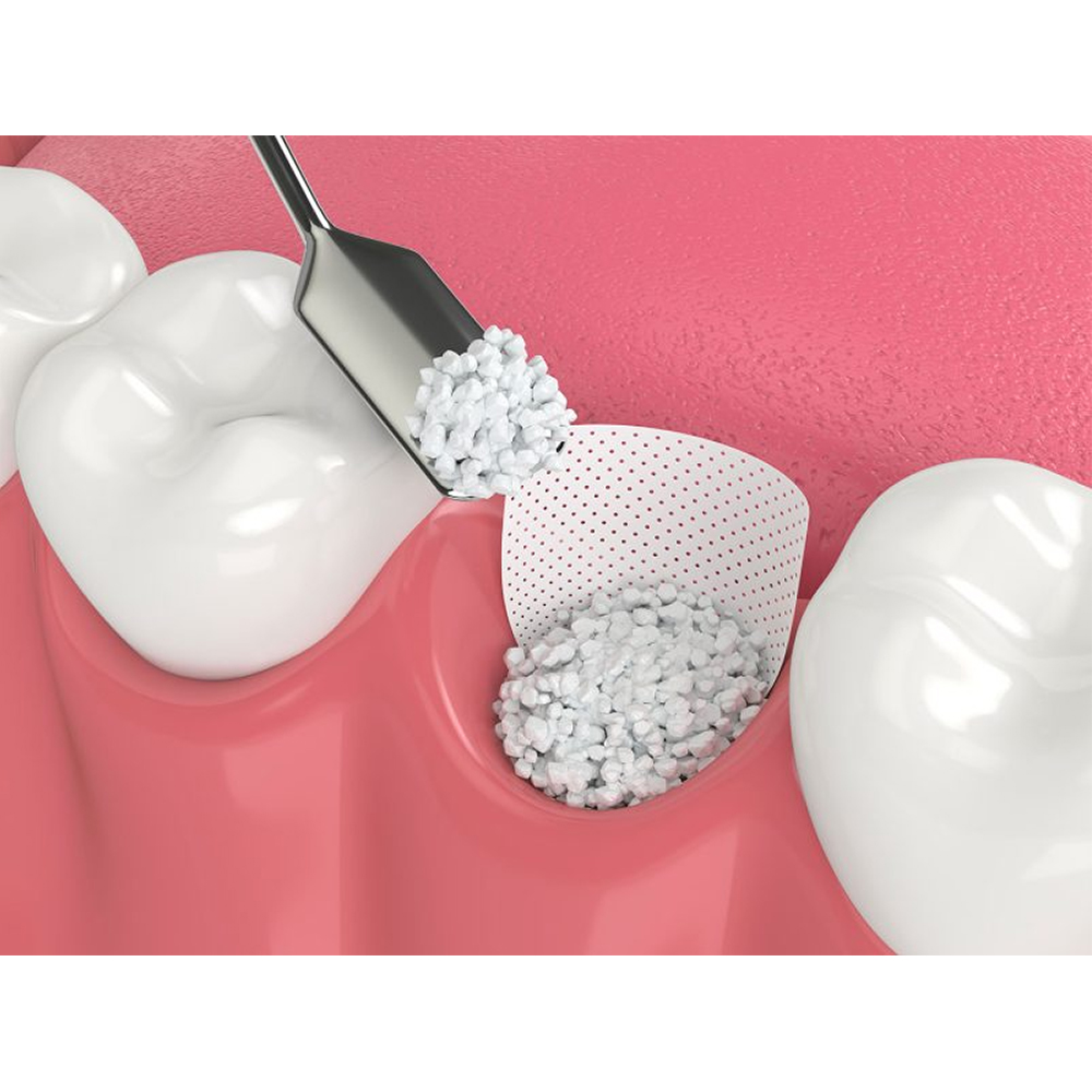 GDC Bone Grafting Instruments