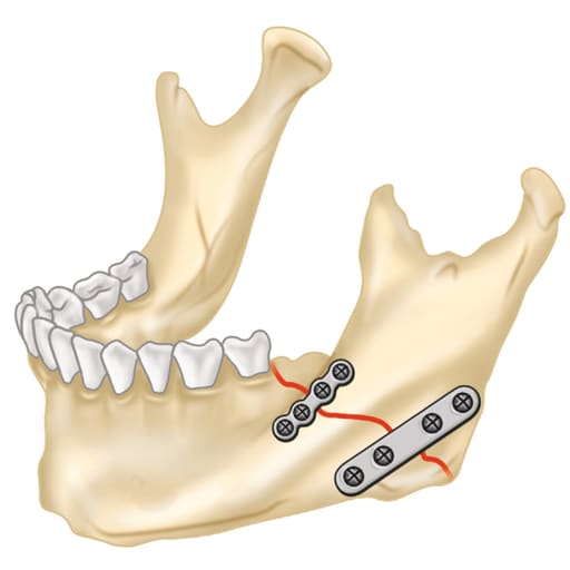 SK Surgicals Titanium Mini Bone Plates Continuous - 2.5mm (Pack of 2)