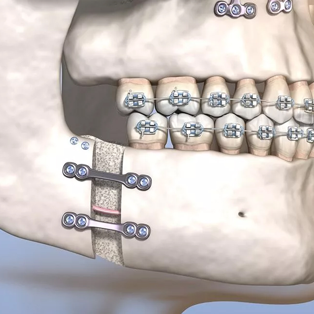 SK Surgicals SS Mini Bone Plates With Gap - 1.5mm