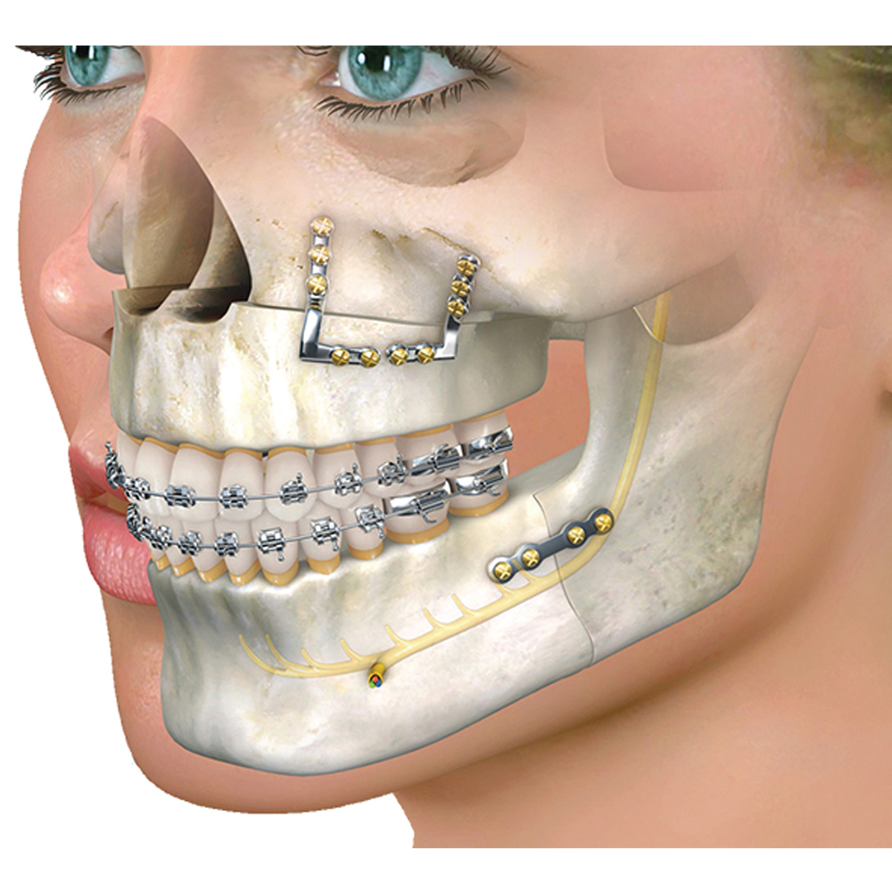 SK Surgicals Titanium Mini Bone Plates With Gap - 2.5mm