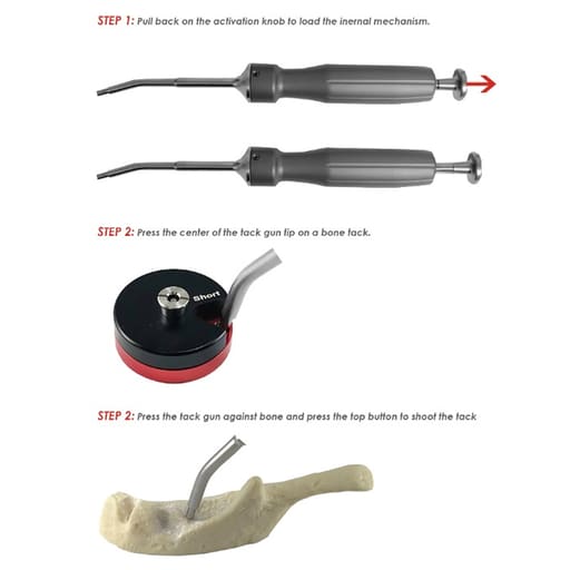 MCTBIO Auto BoneTac Gun & Mini Tack Set (TBM-05)