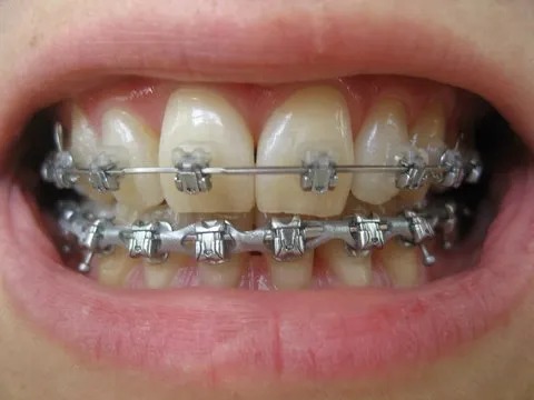 U Ortho E-Chain (15 ft) - Continuous Grey