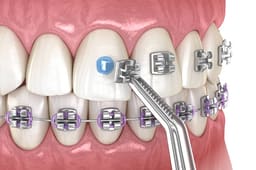 D-Tech Embrace LC Orthodontic Bonding Kit - 5