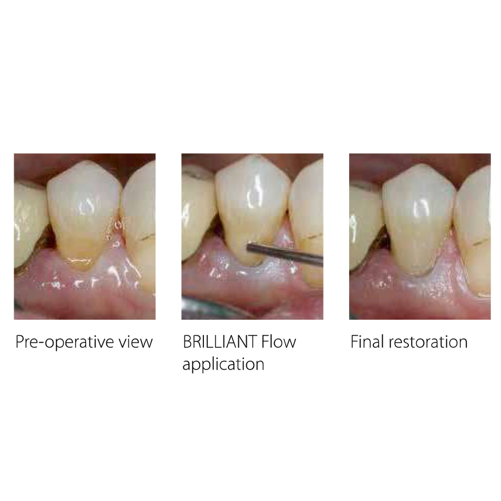 Coltene Whaledent Brilliant Ng Flow Syringes Refills