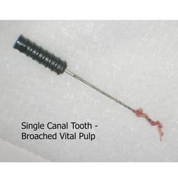 Waldent Barbed Broaches 25mm (Pack of 6) - 18