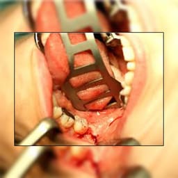 Waldent Bruening Retractor (8/113) - 5