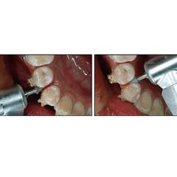 SuperEndo Interproximal Enamel Reduction Bur Kit - 7