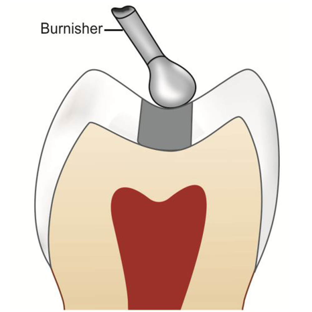 GDC Ball Burnisher - 3 (Bb22/23)