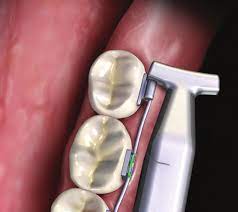 Waldent Orthodontic Hammer Head NiTi Pliers 10/115