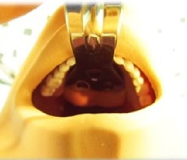 Julldent Weider Cobra Cheek and Tongue Retractors