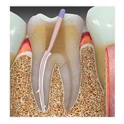 Prime Dental Rc Seal Plus - 5