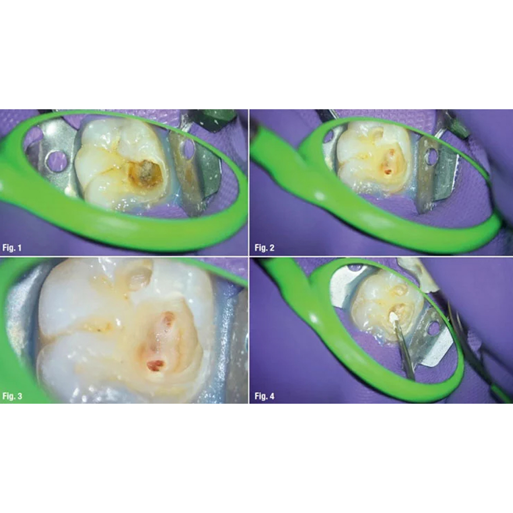 Prime Dental Temporary Filling Calcium Hydroxide Powder 10g Bottle