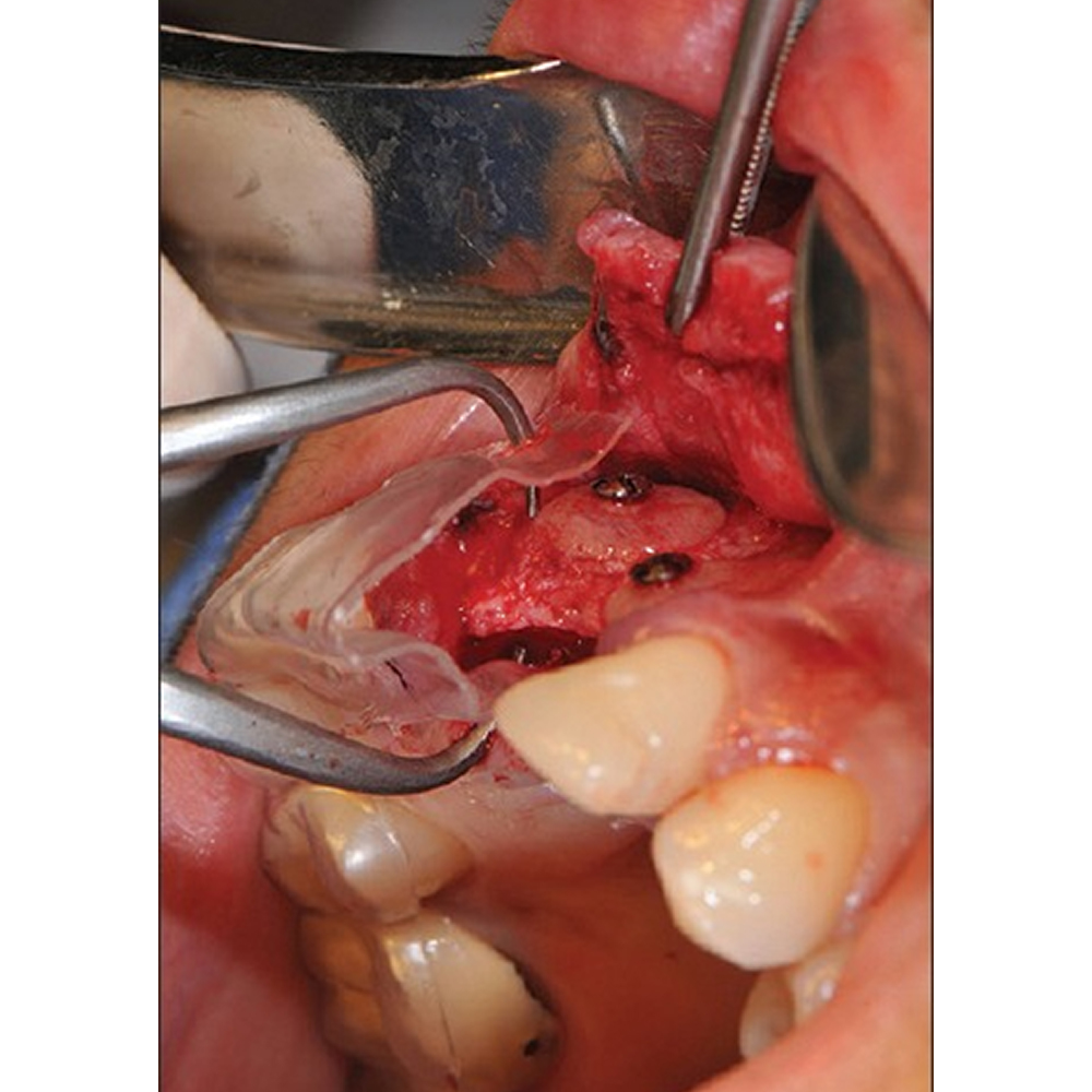 GDC Implantology Bone Caliper with Scale Bc35