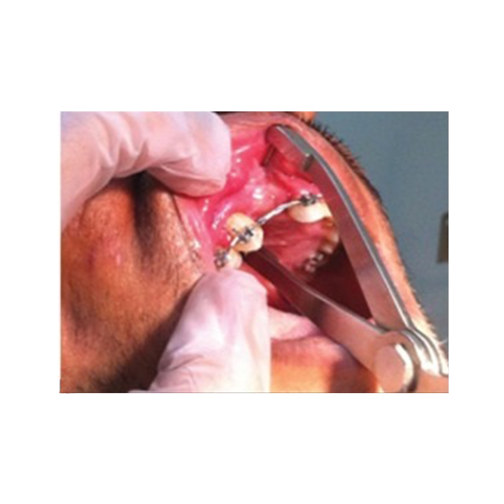 GDC Implantology Bone Caliper Bc15