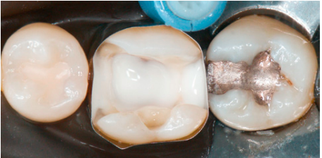 Kulzer Charisma Flow Flowable Composite