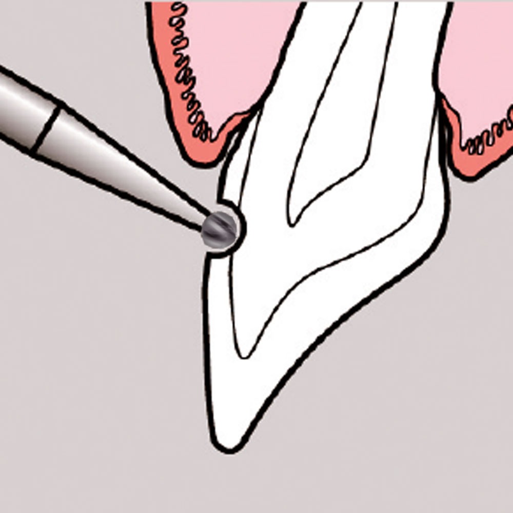 Frank Dental Carbide Bur C.1.018.HP -Pk/1 (Made in Germany)