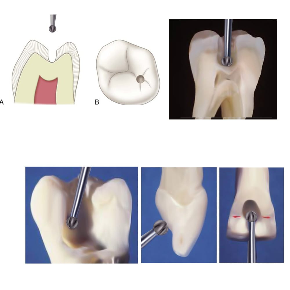 Frank Dental Carbide Bur C.1.018.HP -Pk/1 (Made in Germany)