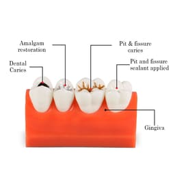 iDENTical Caries Model M4013 - 4