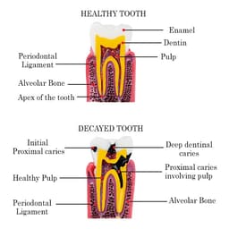 iDENTical Caries V/S Healthy Teeth Model M4021 - 10