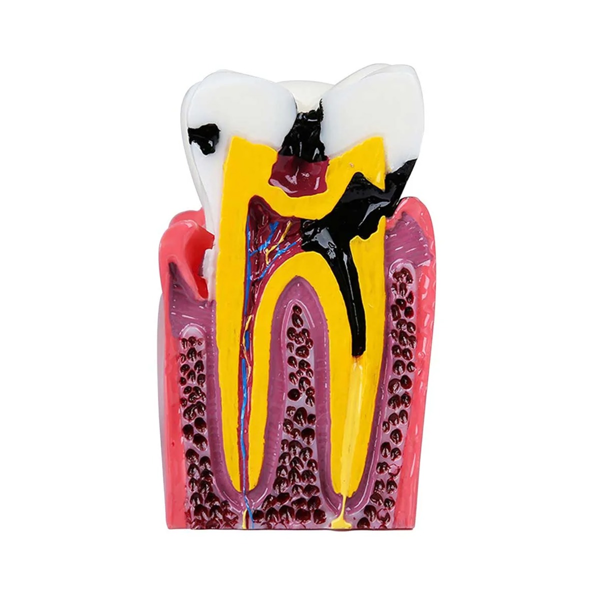 iDENTical Caries V/S Healthy Teeth Model M4021