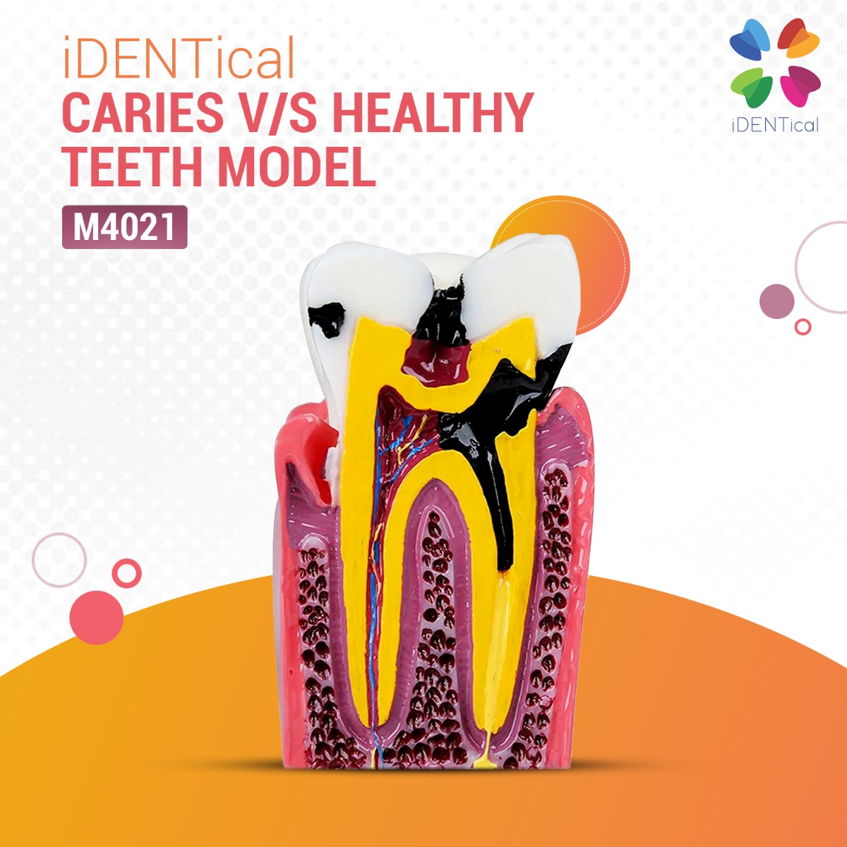 iDENTical Caries V/S Healthy Teeth Model M4021