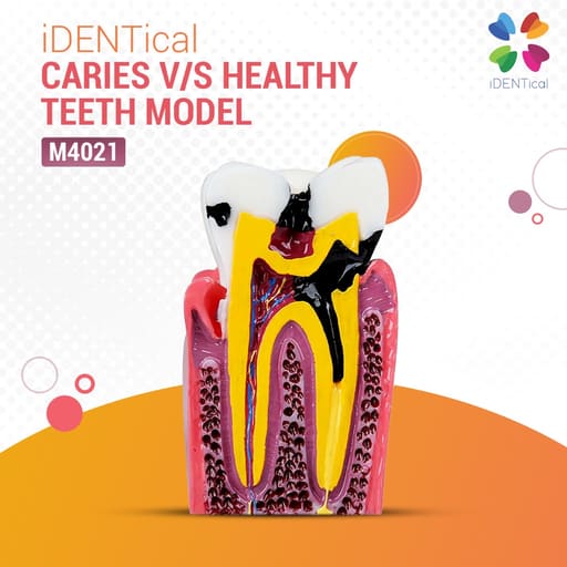 iDENTical Caries V/S Healthy Teeth Model M4021