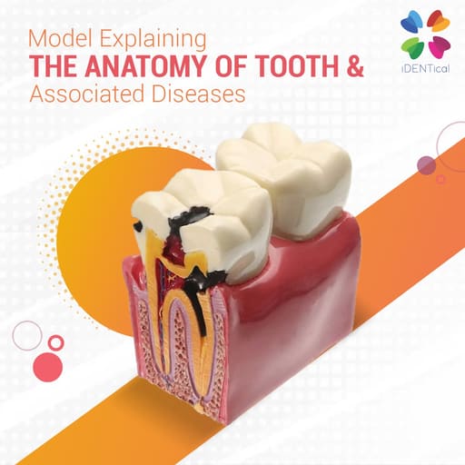 iDENTical Caries V/S Healthy Teeth Model M4021