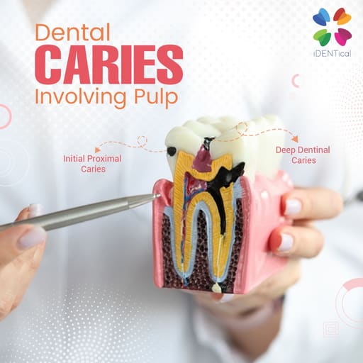 iDENTical Caries V/S Healthy Teeth Model M4021