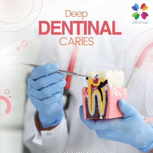 iDENTical Caries V/S Healthy Teeth Model M4021